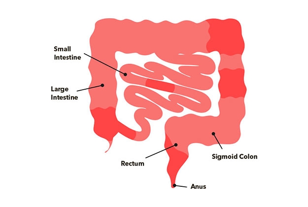 Crohn’s Disease3